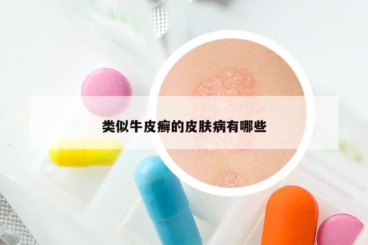 类似牛皮癣的皮肤病有哪些