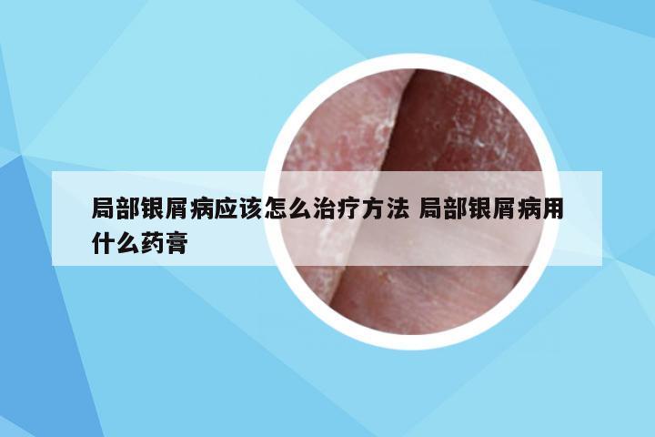 局部银屑病应该怎么治疗方法 局部银屑病用什么药膏