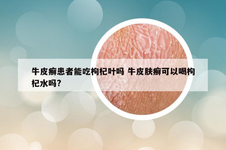 牛皮癣患者能吃枸杞叶吗 牛皮肤癣可以喝枸杞水吗?