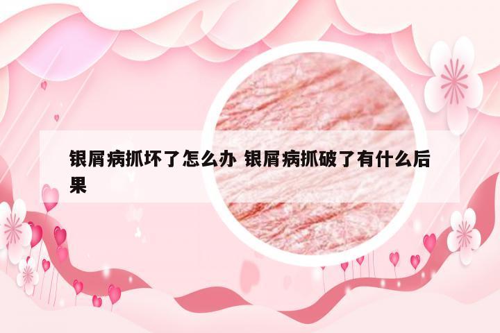 银屑病抓坏了怎么办 银屑病抓破了有什么后果