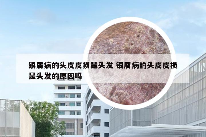银屑病的头皮皮损是头发 银屑病的头皮皮损是头发的原因吗