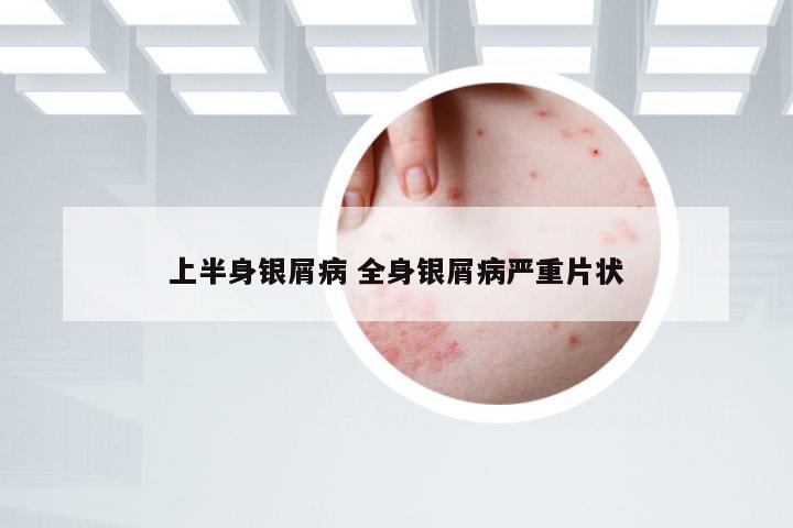 上半身银屑病 全身银屑病严重片状