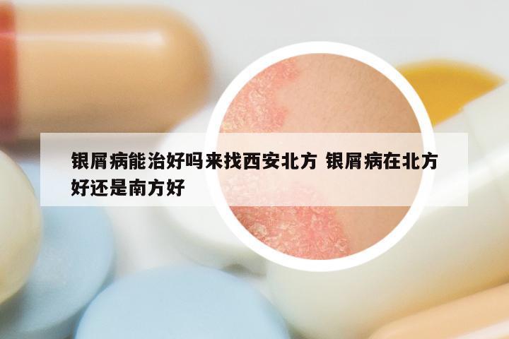 银屑病能治好吗来找西安北方 银屑病在北方好还是南方好