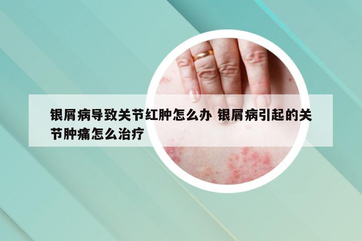 银屑病导致关节红肿怎么办 银屑病引起的关节肿痛怎么治疗