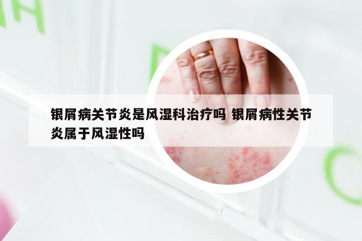 银屑病关节炎是风湿科治疗吗 银屑病性关节炎属于风湿性吗