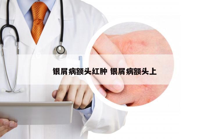 银屑病额头红肿 银屑病额头上
