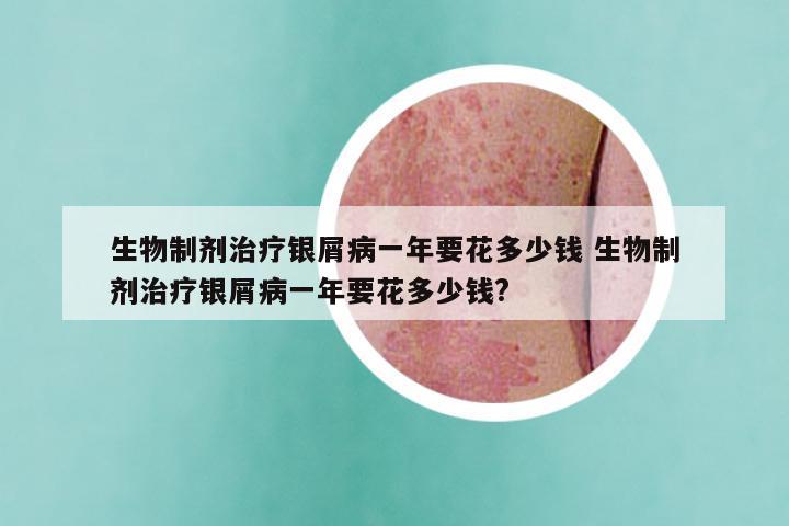 生物制剂治疗银屑病一年要花多少钱 生物制剂治疗银屑病一年要花多少钱?
