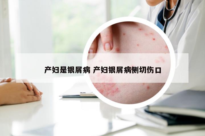 产妇是银屑病 产妇银屑病侧切伤口