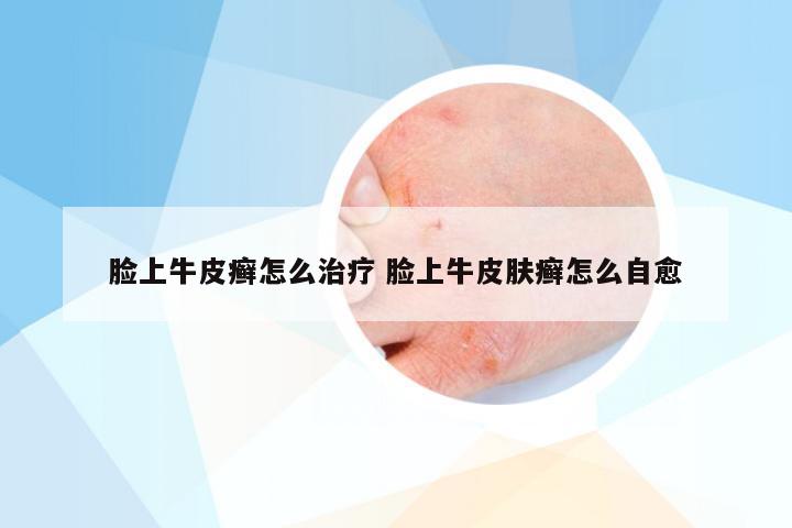 脸上牛皮癣怎么治疗 脸上牛皮肤癣怎么自愈