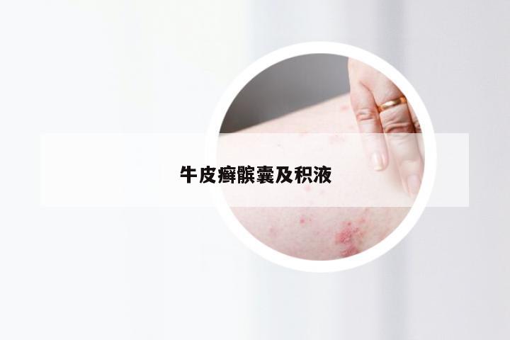 牛皮癣髌囊及积液