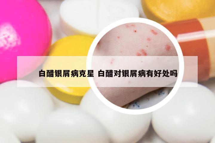 白醋银屑病克星 白醋对银屑病有好处吗