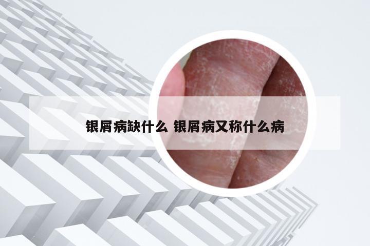 银屑病缺什么 银屑病又称什么病