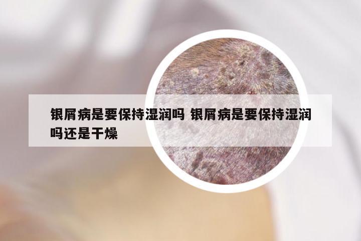 银屑病是要保持湿润吗 银屑病是要保持湿润吗还是干燥