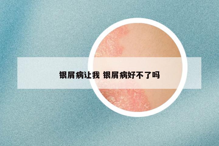 银屑病让我 银屑病好不了吗