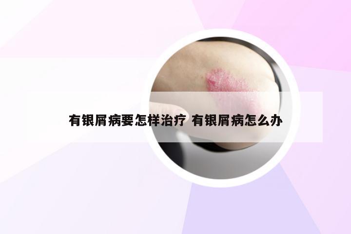 有银屑病要怎样治疗 有银屑病怎么办