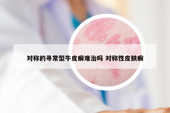 对称的寻常型牛皮癣难治吗 对称性皮肤癣