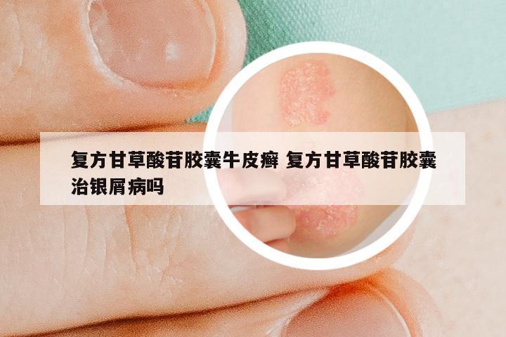 复方甘草酸苷胶囊牛皮癣 复方甘草酸苷胶囊治银屑病吗