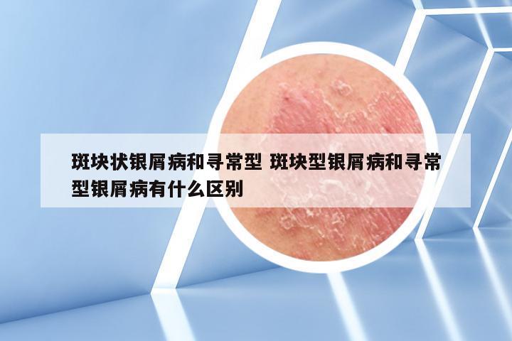 斑块状银屑病和寻常型 斑块型银屑病和寻常型银屑病有什么区别