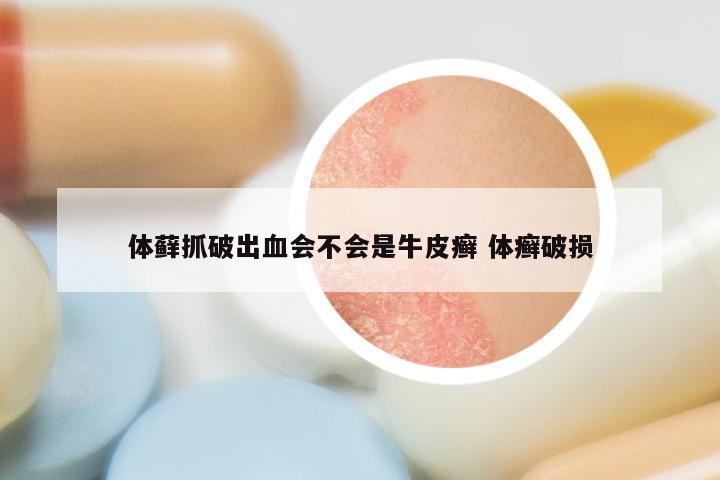 体藓抓破出血会不会是牛皮癣 体癣破损