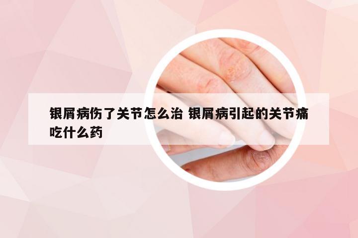 银屑病伤了关节怎么治 银屑病引起的关节痛吃什么药