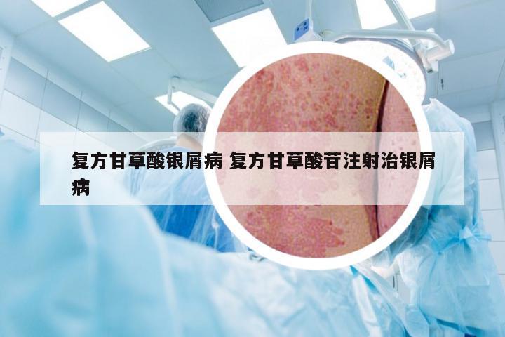 复方甘草酸银屑病 复方甘草酸苷注射治银屑病