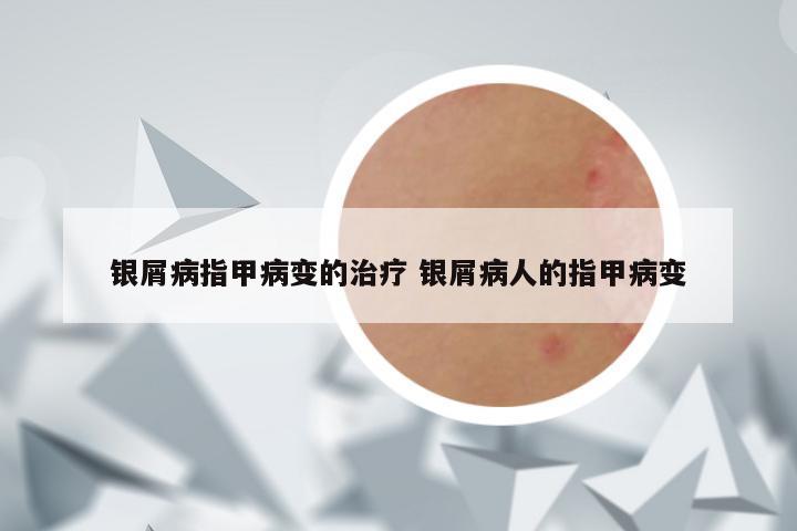 银屑病指甲病变的治疗 银屑病人的指甲病变