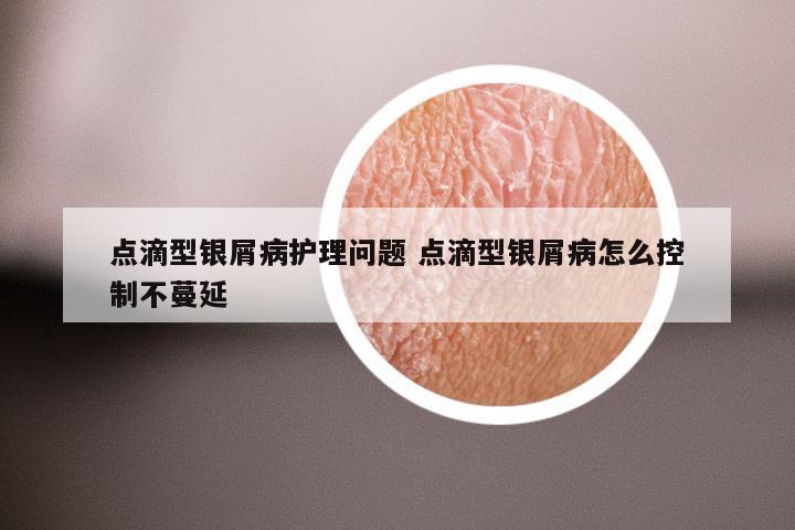 点滴型银屑病护理问题 点滴型银屑病怎么控制不蔓延