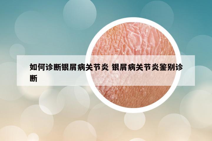 如何诊断银屑病关节炎 银屑病关节炎鉴别诊断