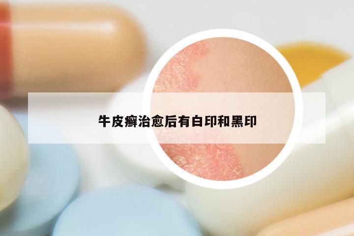 牛皮癣治愈后有白印和黑印