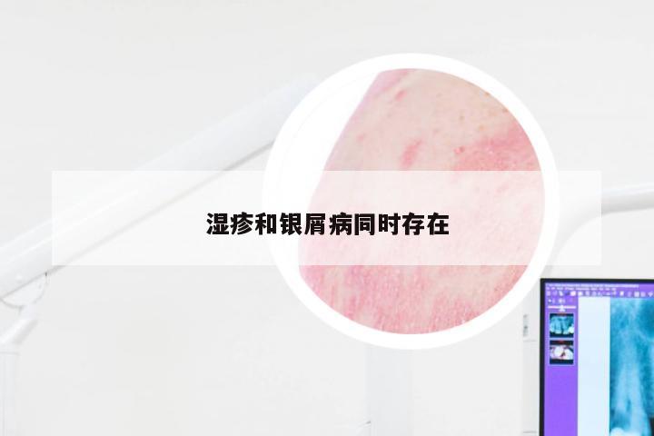 湿疹和银屑病同时存在
