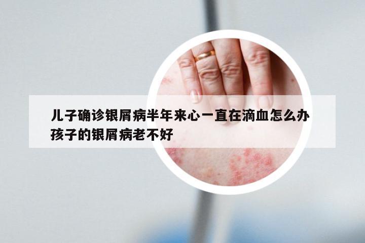 儿子确诊银屑病半年来心一直在滴血怎么办 孩子的银屑病老不好