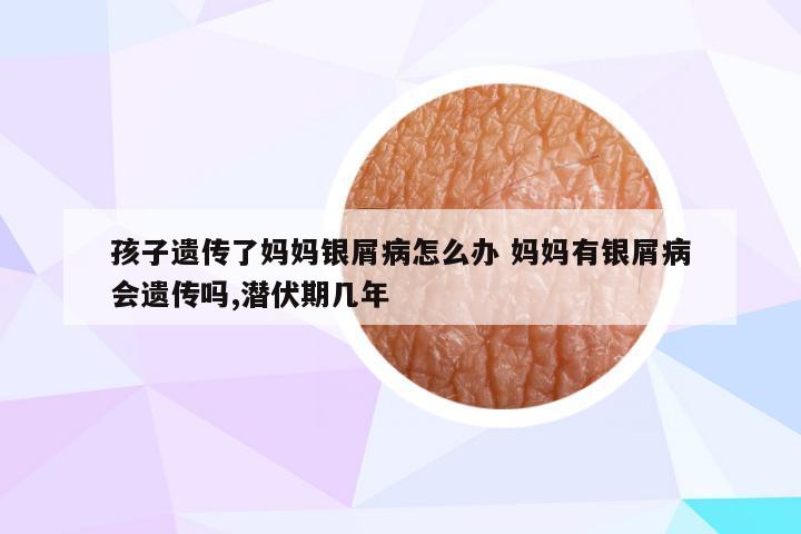 孩子遗传了妈妈银屑病怎么办 妈妈有银屑病会遗传吗,潜伏期几年