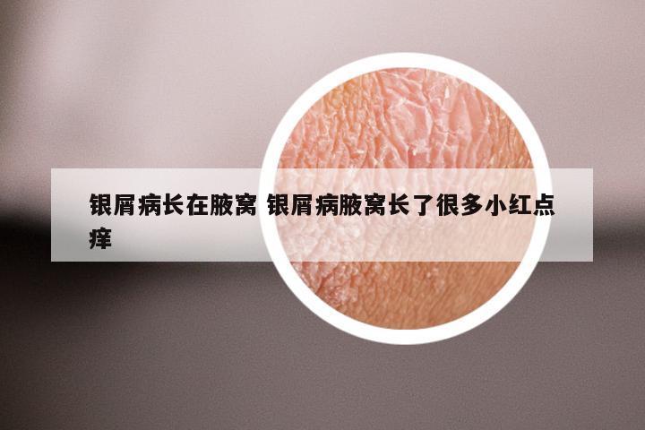 银屑病长在腋窝 银屑病腋窝长了很多小红点痒