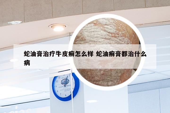 蛇油膏治疗牛皮癣怎么样 蛇油癣膏都治什么病