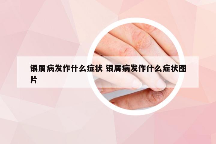 银屑病发作什么症状 银屑病发作什么症状图片