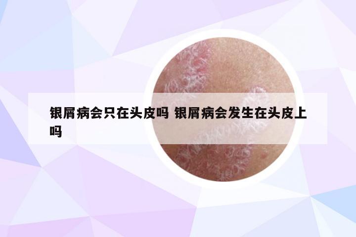 银屑病会只在头皮吗 银屑病会发生在头皮上吗