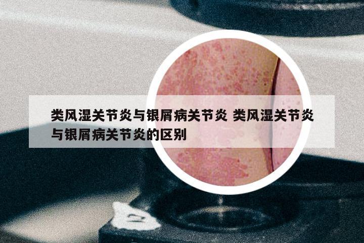 类风湿关节炎与银屑病关节炎 类风湿关节炎与银屑病关节炎的区别
