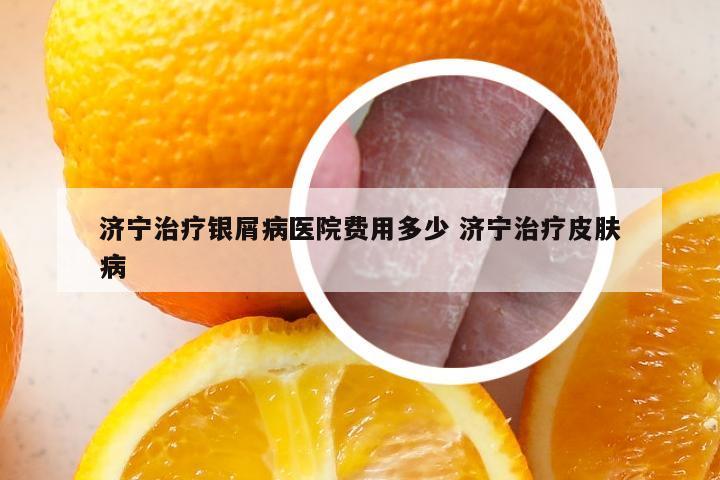 济宁治疗银屑病医院费用多少 济宁治疗皮肤病