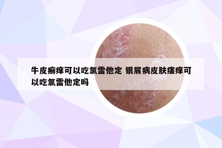 牛皮癣痒可以吃氯雷他定 银屑病皮肤瘙痒可以吃氯雷他定吗