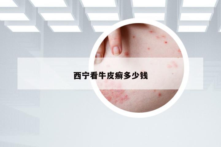 西宁看牛皮癣多少钱