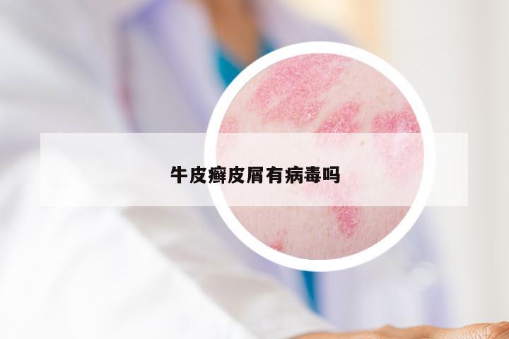 牛皮癣皮屑有病毒吗