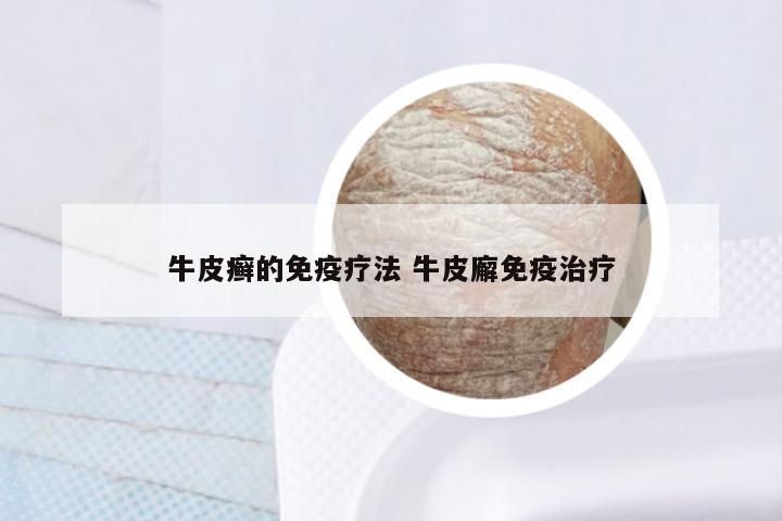 牛皮癣的免疫疗法 牛皮廨免疫治疗