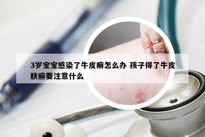 3岁宝宝感染了牛皮癣怎么办 孩子得了牛皮肤癣要注意什么