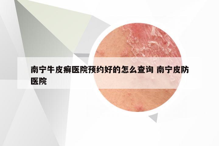 南宁牛皮癣医院预约好的怎么查询 南宁皮防医院