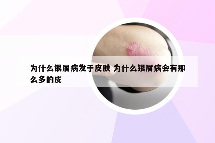 为什么银屑病发于皮肤 为什么银屑病会有那么多的皮