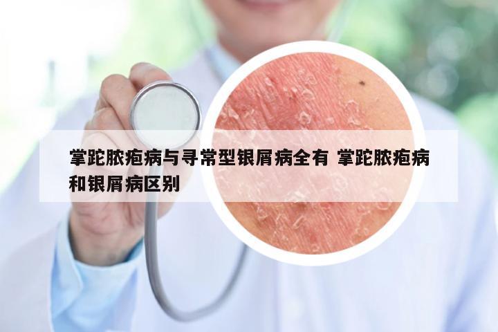掌跎脓疱病与寻常型银屑病全有 掌跎脓疱病和银屑病区别
