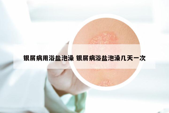 银屑病用浴盐泡澡 银屑病浴盐泡澡几天一次