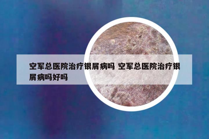 空军总医院治疗银屑病吗 空军总医院治疗银屑病吗好吗