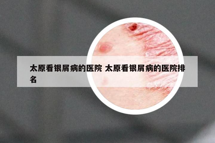 太原看银屑病的医院 太原看银屑病的医院排名