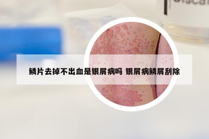 鳞片去掉不出血是银屑病吗 银屑病鳞屑刮除
